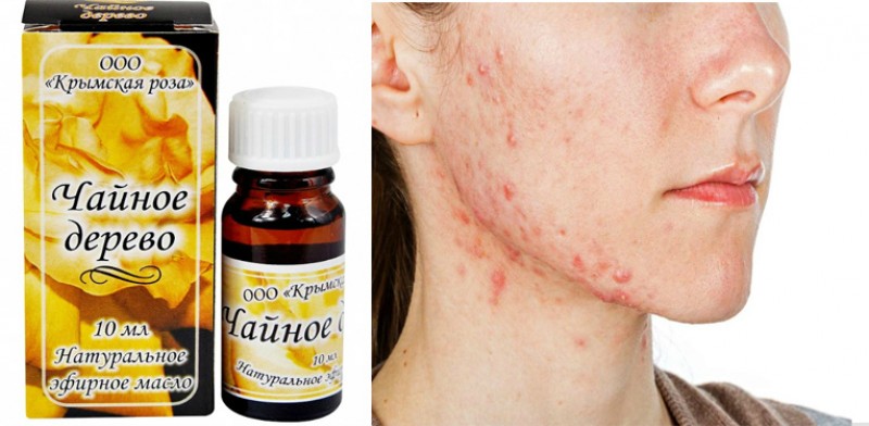 масло чайного дерева от прыщей. эфирное масло чайного дерева. чайное дерево от прыщей на лице. чайное дерево от прыщей на лице. чайное дерево от прыщей на лице.