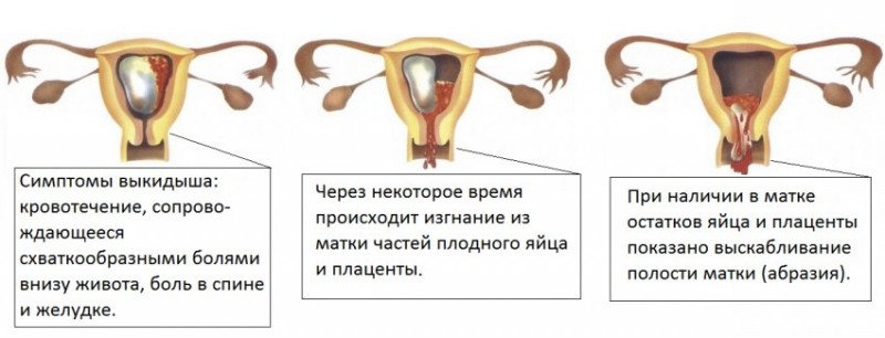 операция выскабливания слизистой оболочки матки для удаления патологических образований при некоторых её заболеваниях (например, при нарушениях менструального цикла), а также плодного яйца и его оболочек с целью прекращения беременности (так называемый искусственный аборт) или при выкидыше.