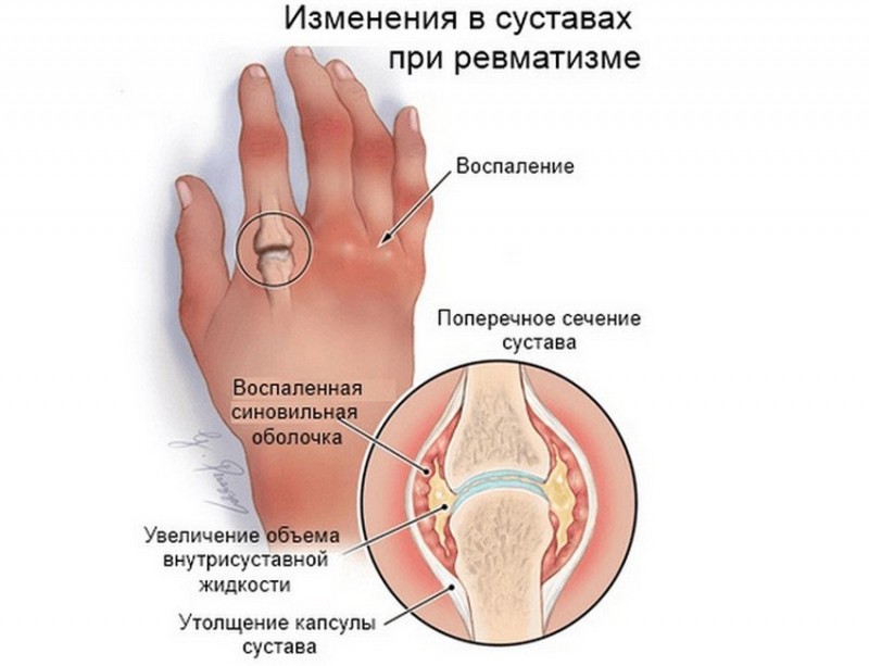 Клиническая картина при ревматизме